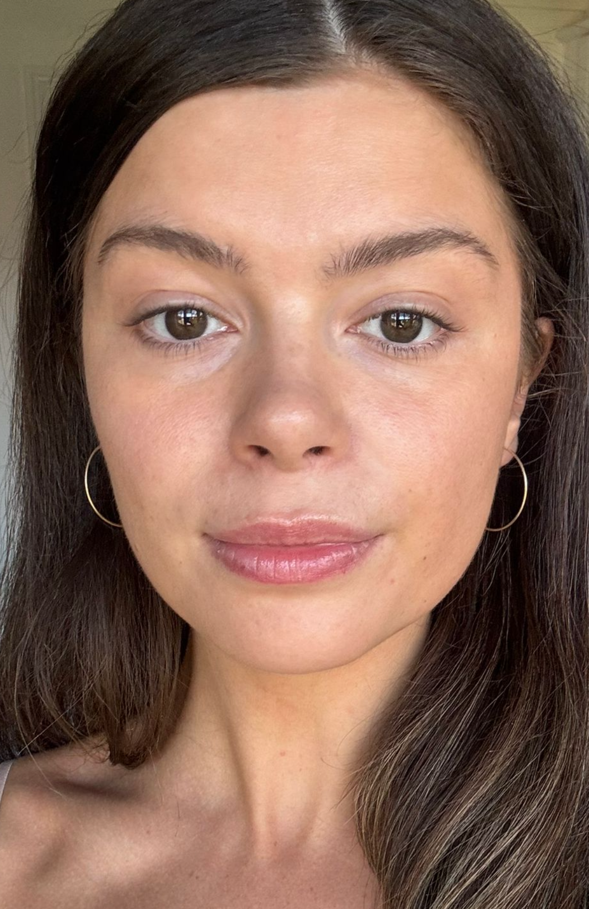 Before Masseter Botox Treatment