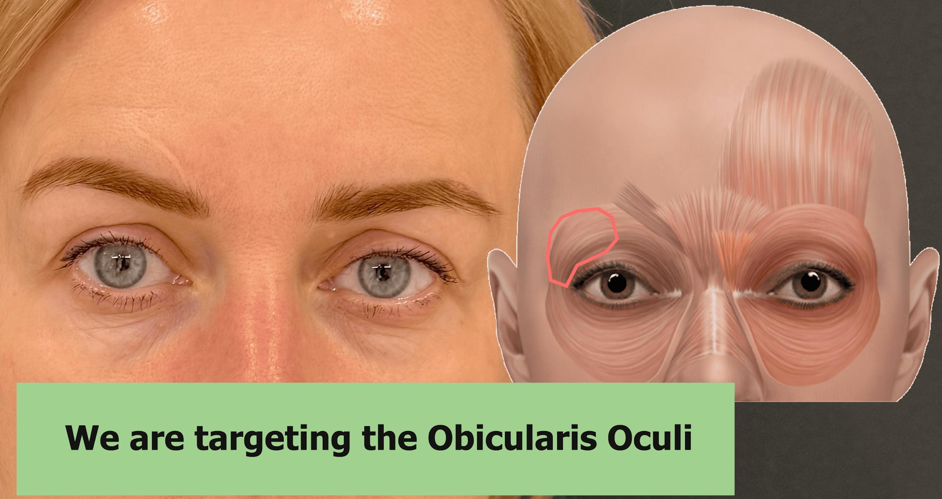 Before considerations for brow lift botox – mapping and symmetry