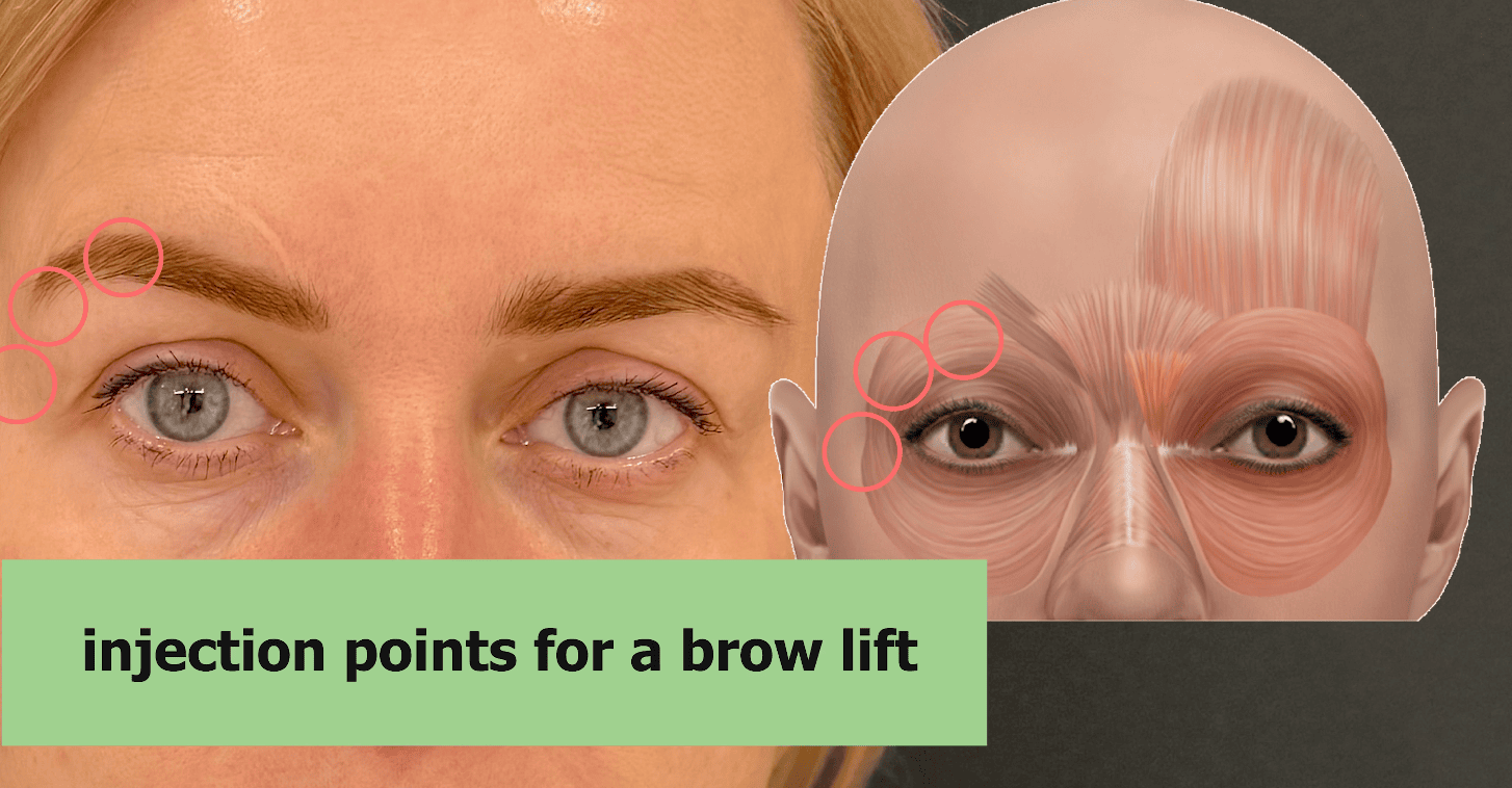 Brow lift botox planning across the upper face