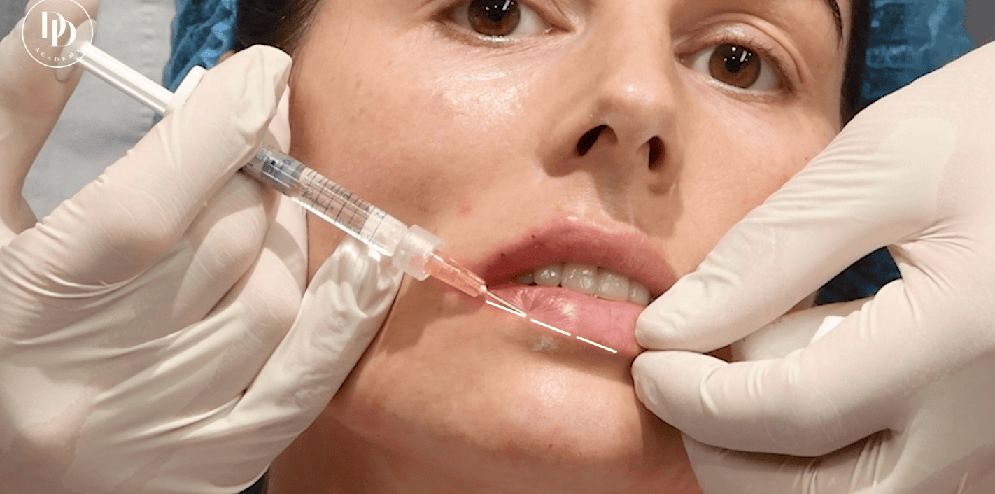 Lip injection techniques – border and body planes