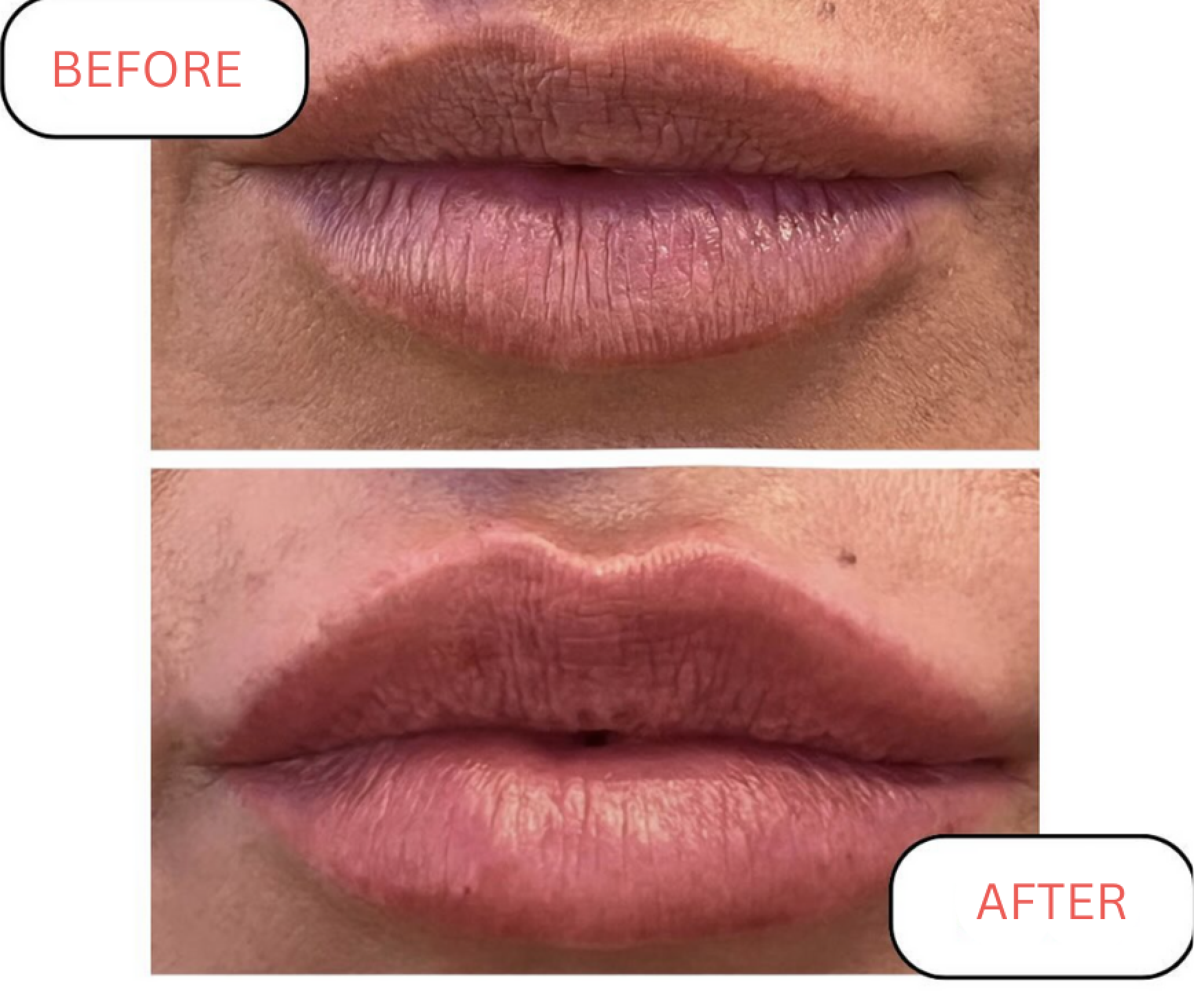 Lip filler training before and after