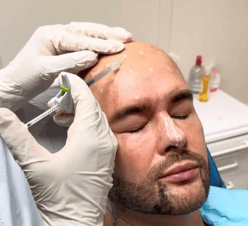 Botox marking in men London aesthetic training