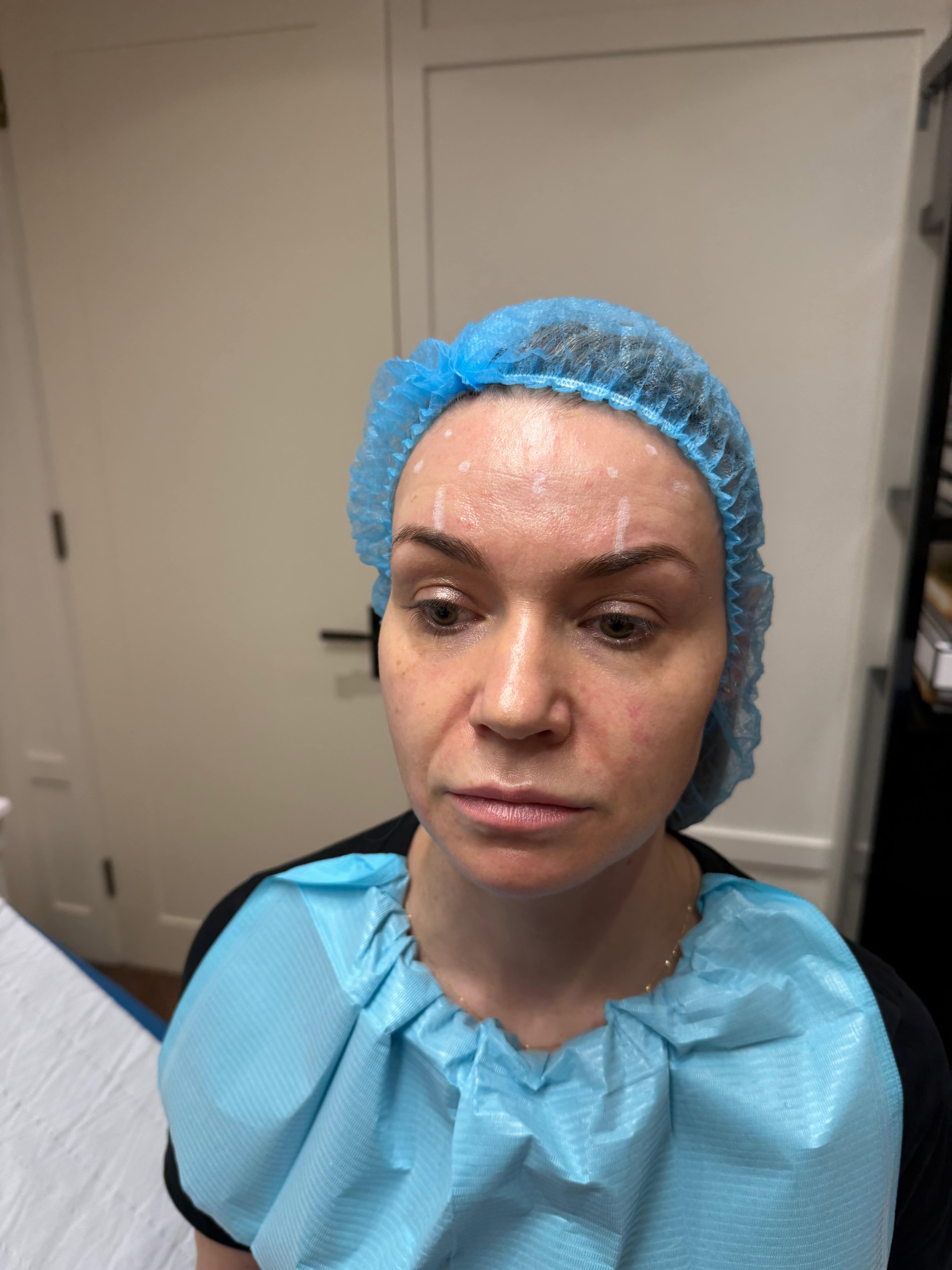 Botox marking in women advanced doctors training