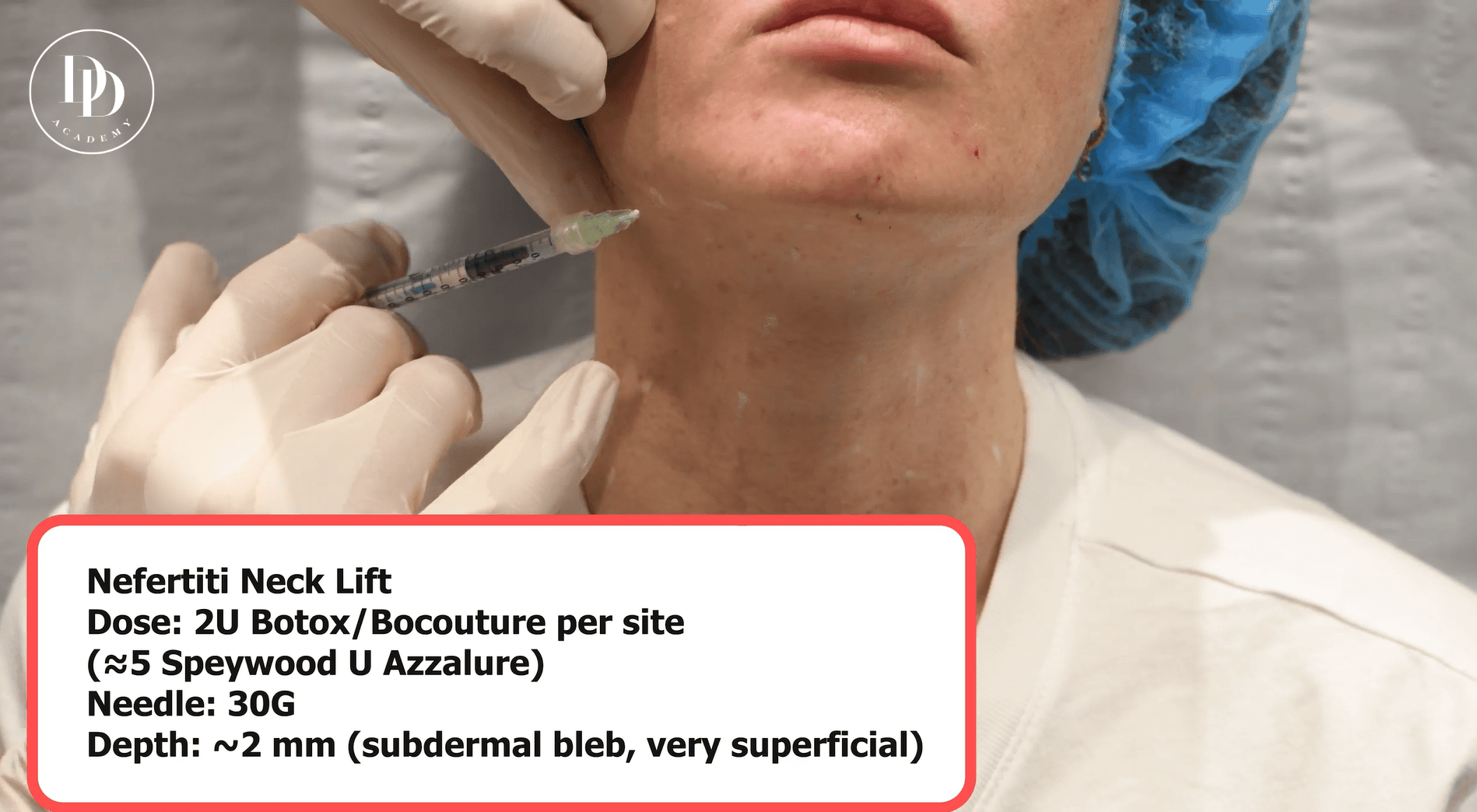 Neck botox injection points showing platysmal bands and Nefertiti lift mandibular border technique