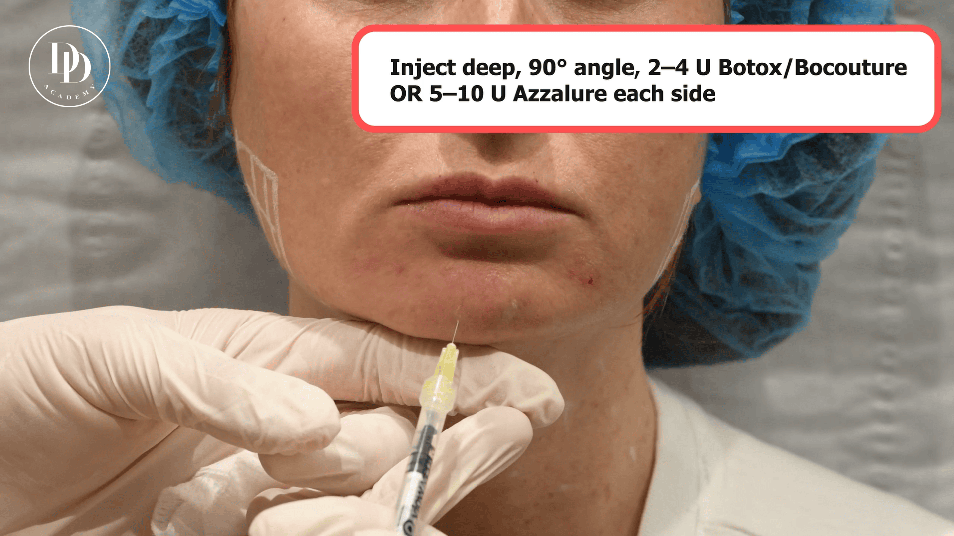 lower face anatomy mentalis depressor labii inferioris botox guide