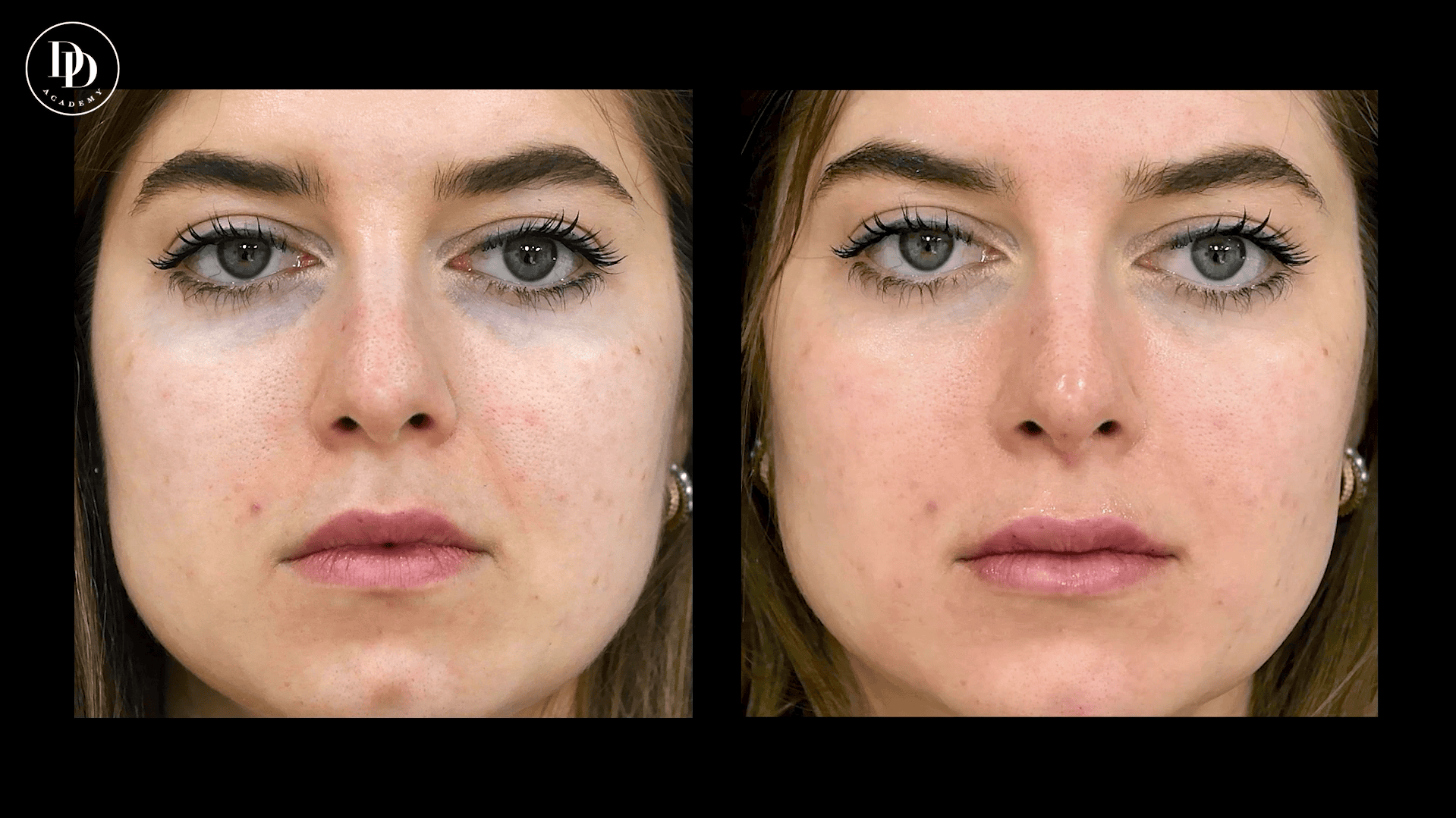 nasolabial lines filler before and after aesthetic treatment results