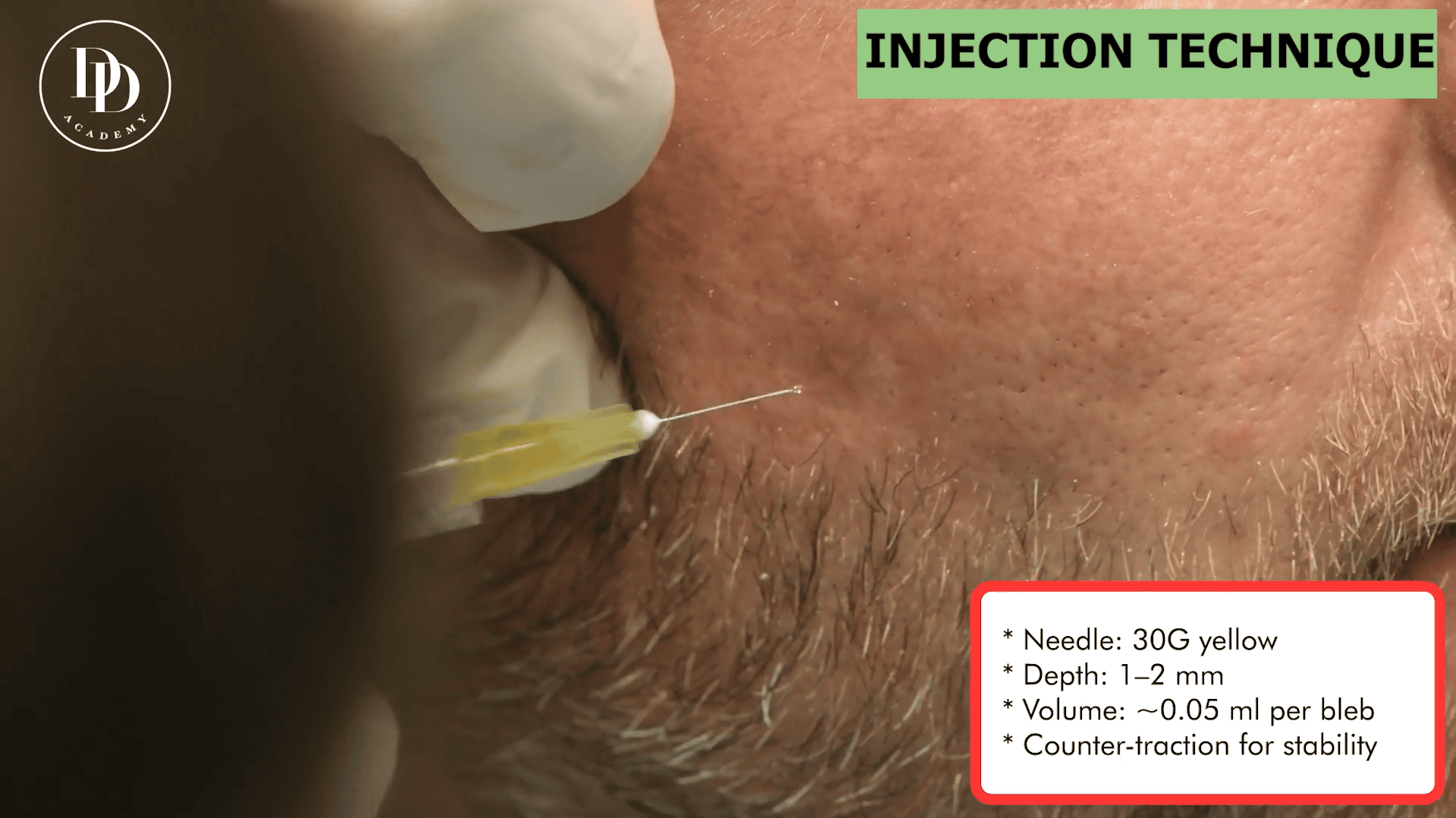 PRP facial injection technique training on live model Harley Street