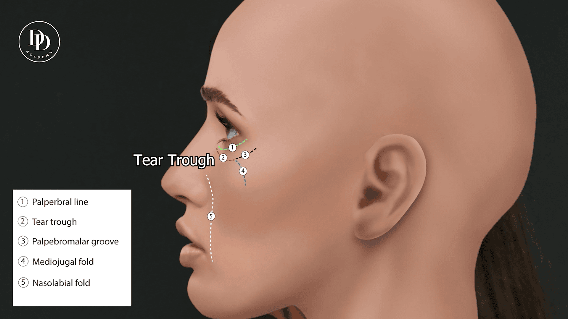 Tear trough anatomy showing ligament structures and infraorbital injection zones for dermal filler placement