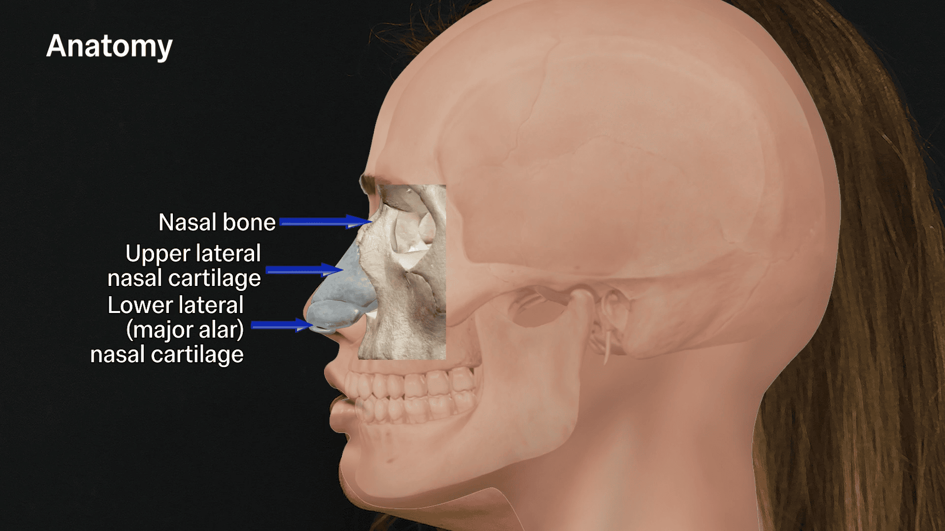 nasal anatomy injection zones for non-surgical rhinoplasty